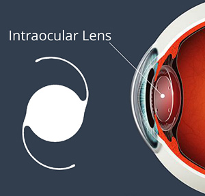 Cataract Intraocular Lens